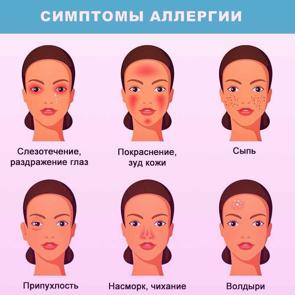 Симптомы аллергии Схема с симптомами аллергии