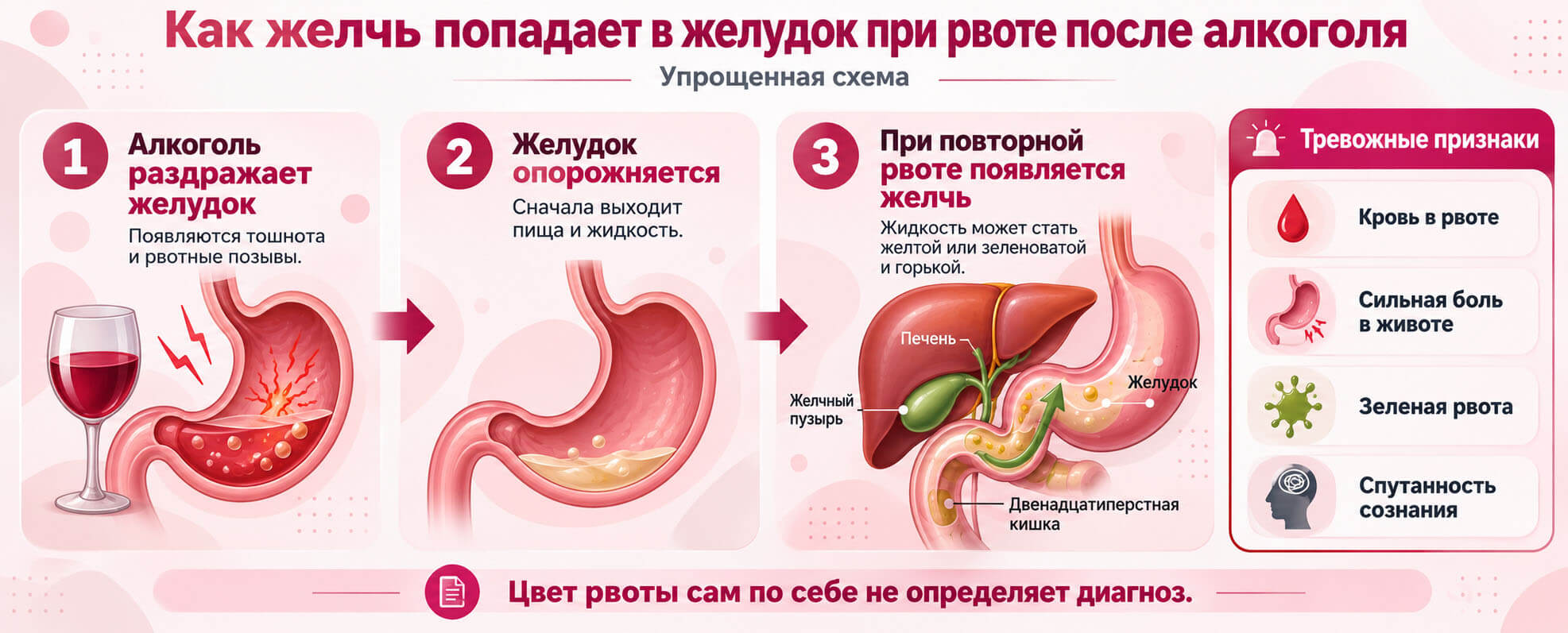 Инфографика: как желчь попадает в желудок при рвоте после алкоголя, механизм обратного заброса из двенадцатиперстной кишки